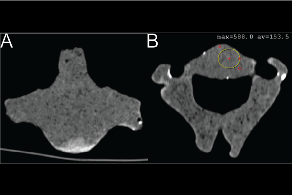 CT scan of fabricated spine segment